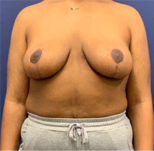 Breast-Reduction-Case--27281 | After Breast Reduction 1