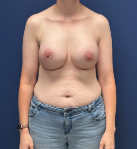 Breast-Augmentation-Case--28670 | After Breast Augmentation 1