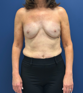 Breast-Reconstruction-Case--28688 | After Breast Reconstruction 1