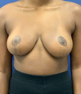 Breast-Reduction-Case--27254 | After Breast Reduction 1
