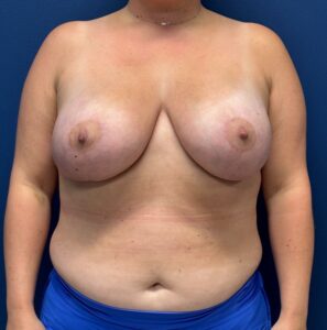 Breast-Augmentation-Mastopexy-Case--29079 | After Breast Augmentation With Lift 1