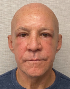 Blepharoplasty-Case--24169 | After Eyelid Surgery 2