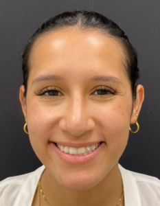 Rhinoplasty-Case--376 | After Rhinoplasty 1