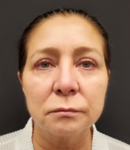 Blepharoplasty-Case--358 | After Eyelid Surgery 1