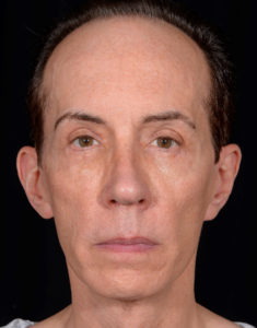 Blepharoplasty-Case--357 | After Eyelid Surgery 1