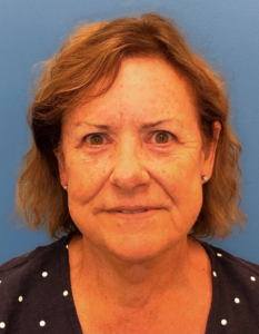 Facelift-Case--14406 | After Neck Lift 1