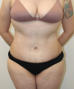 Liposuction-Tummy-Tuck-Case--343 | After Liposuction 1