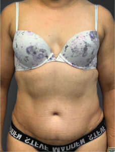 Abdominoplasty-Case--2637 | After Tummy Tuck 1