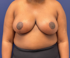 Breast-Reduction-Case--240 | After Breast Reduction 1