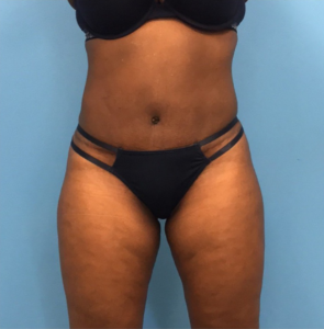 Case--246 | After Liposuction 1