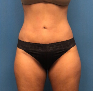Lipo-360-Case--277 | After Liposuction 1