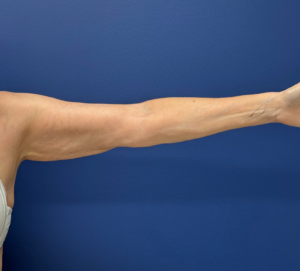 Liposuction-Case--23690-2 | After Liposuction 1