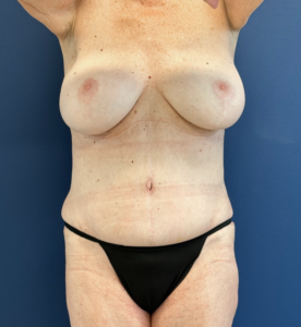 Tummy-Tuck-Liposuction-Case--27935 | After Liposuction 2