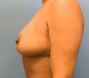 Breast-Reduction-Case--131 | After Breast Reduction 2
