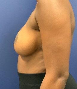 Breast-Reduction-Case--27254 | After Breast Reduction 2