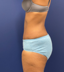 Abdominoplasty-Case--24922 | After Liposuction 2