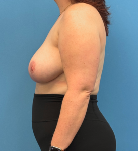 Breast-Reduction-Case--28338 | After Breast Reduction 2