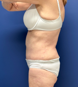 Liposuction-Tummy-Tuck-Case--23690 | After Liposuction 2