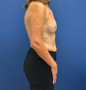 Breast-Reconstruction-Case--28688 | After Breast Reconstruction 2