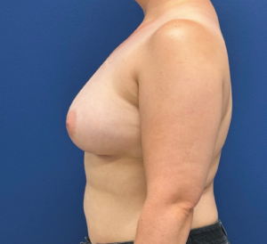 Breast-Reconstruction-Case--28689 | After Breast Reconstruction 2