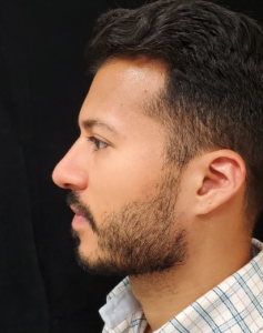 Rhinoplasty-Case--379 | After Rhinoplasty 2