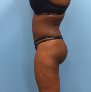 Case--246 | After Liposuction 2