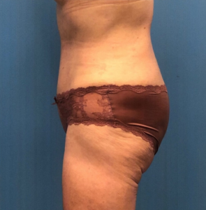 Case--251 | After Liposuction 2