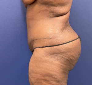 Case--257 | After Liposuction 2