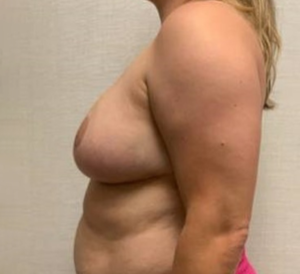 Case--26525 | After Breast Reconstruction 2