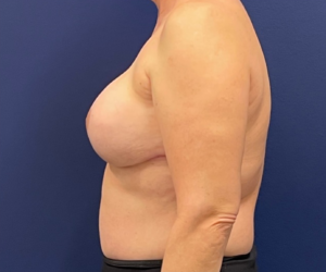 Breast-Reconstruction-Case--308 | After Breast Reconstruction 2