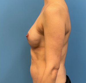 Breast-Reconstruction-Case--25209 | After Breast Reconstruction 2