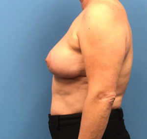 Case--314 | After Breast Reconstruction 2