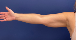 Case--399 | After Liposuction 1