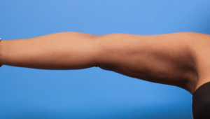 Case--279 | After Liposuction 1