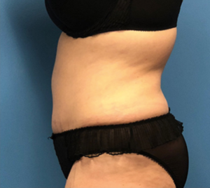 Case--56 | After Liposuction 2