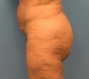 Brazilian-butt-lift-Case--74 | After Brazilian Butt Lift 1