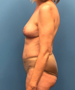 Case--17297 | After Breast Lift 2