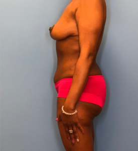 Mommy-Makeover-Case--13869 | After Mommy Makeover 2