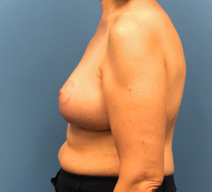 Breast-Reduction-Case--13180 | After Breast Reduction 2