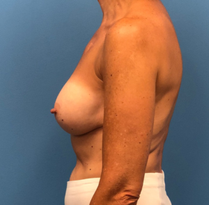 Revision-Augmentation--13287 | After Revision Augmentation 2