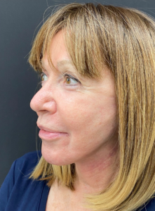 Facelift-Case--365 | After Facelift 2