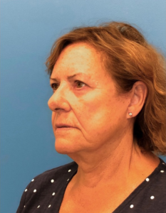 Facelift-Case--14406 | After Neck Lift 2