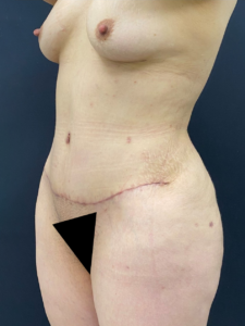 Lipoabdominoplasty-Case--339 | After Liposuction 2