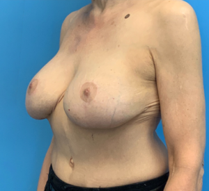 Breast-Augmentation-Mastopexy-Case--24958 | After Revision Augmentation 2