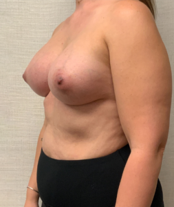 After Breast Augmentation (Left Oblique)