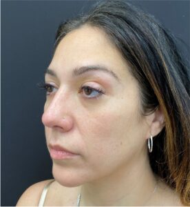Rhinoplasty-Case--377 | After Rhinoplasty 1
