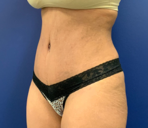 Tummy-Tuck-Case--21755 | After Tummy Tuck 2