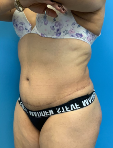 Tummy-Tuck-Case--25988 | After Tummy Tuck 2