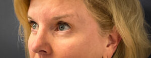 Blepharoplasty-Case--7015 | After Eyelid Surgery 2