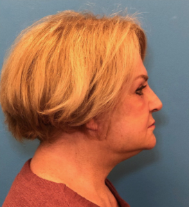 Facelift-Case--14460 | After Facelift 2